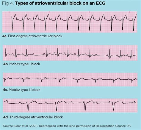 Abnormal Ecg Examples