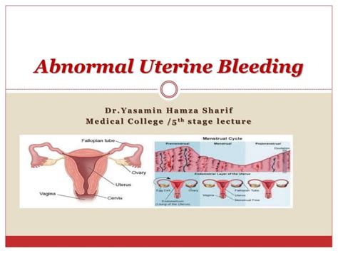Abnormal Uterine Bleeding Ppt