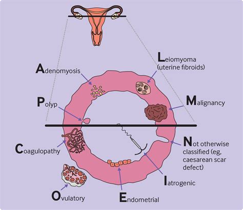 Read Online Abnormal Uterine Bleeding In Reproductive Aged Women 
