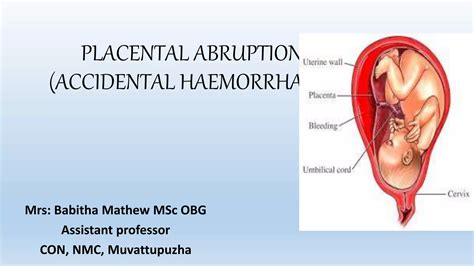 Abruptio Placenta Ppt