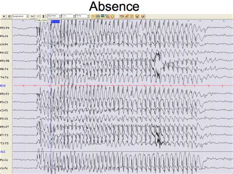 absence epilepsie