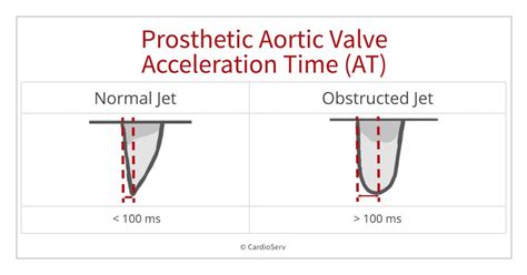 Acceleration Time Aortic Valve