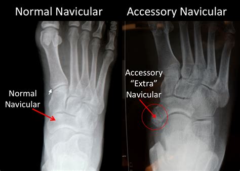 Accessory Navicular Bone X Ray
