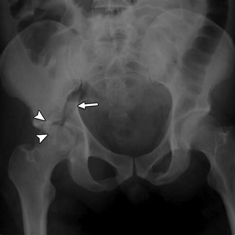 Read Online Acetabular Fractures Anatomic And Clinical Considerations 