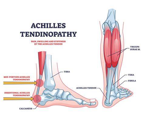achilles tendon pathology an issue of clinics in