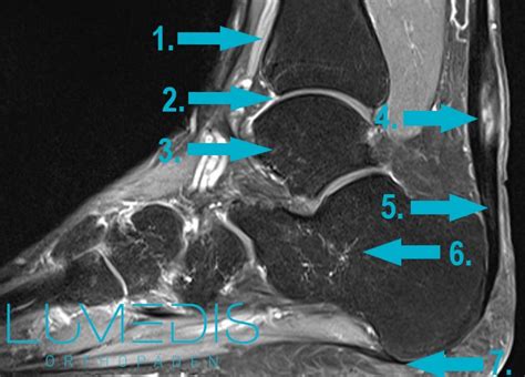 achillessehne mrt oder ct