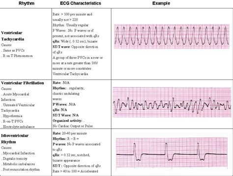 Acls Ecg Rhythms