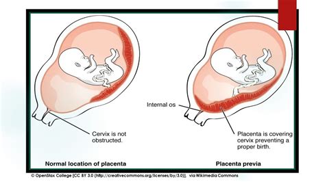 Acog Placenta Previa