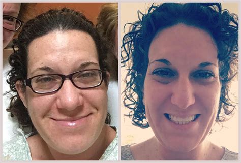 acromegaly before and after