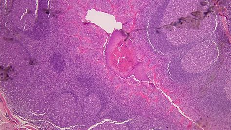 Actinomyces Bacteria In Tonsils