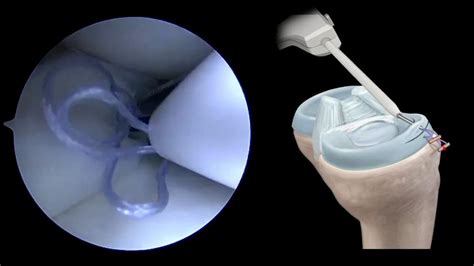 acufex meniscal repair system