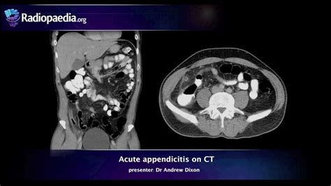 Acute Appendicitis Ct Scan