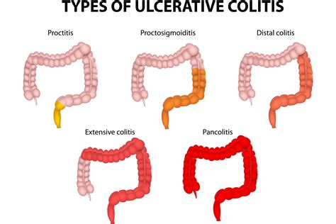 acute colitis gay