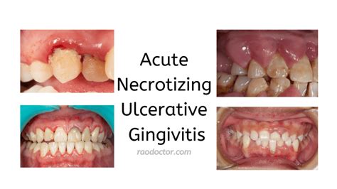 Acute Necrotising Ulcerative Gingivitis