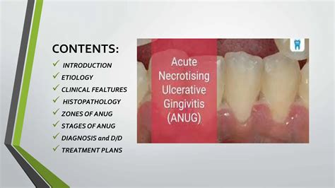 Acute Necrotizing Ulcerative Gingivitis