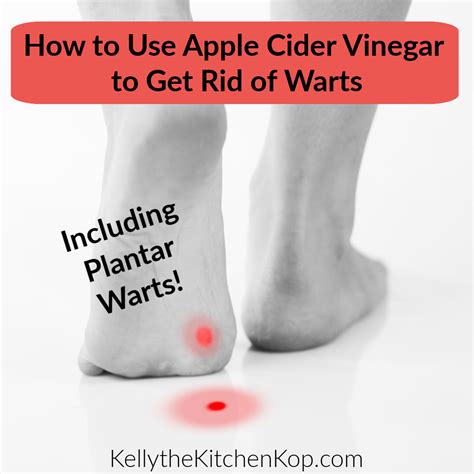 Acv For Warts