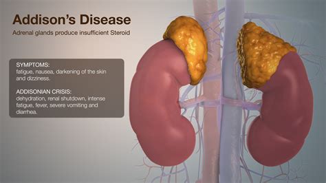 Addison's Disease Ppt