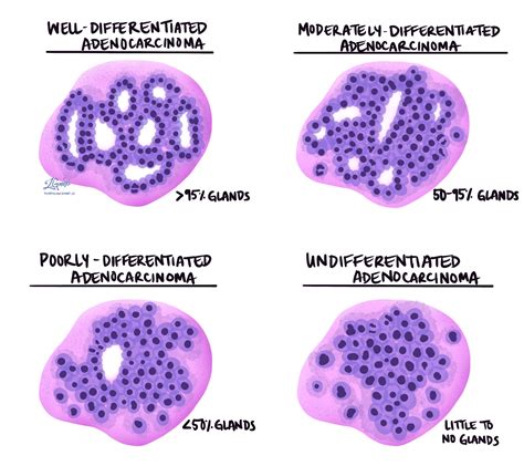 adenocarcinom prognos