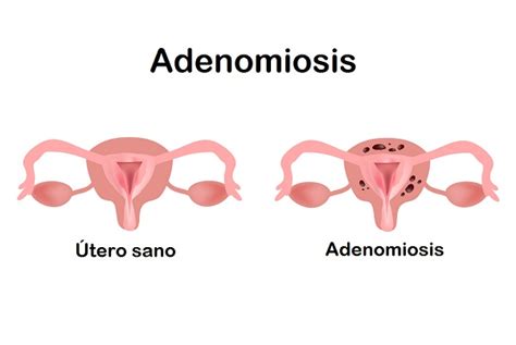 adenomiosis