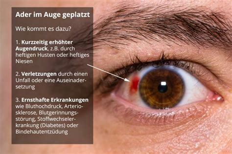adern geplatzt auge