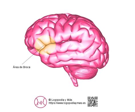 Afasia De Broca