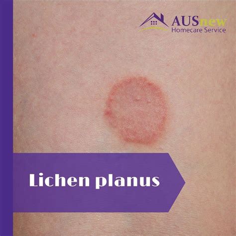 afbeelding lichen planus