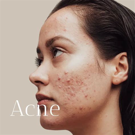 akne behandling apoteket