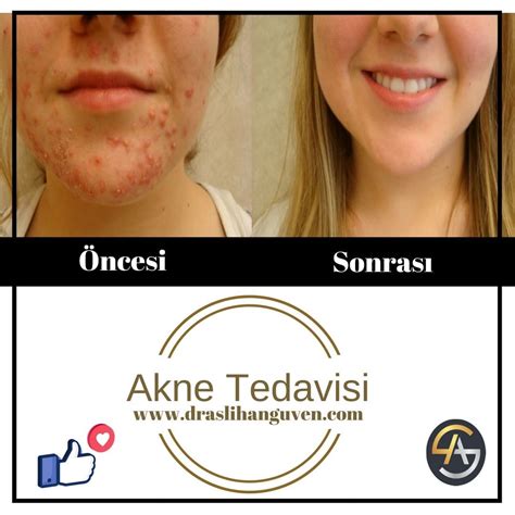 akne tedavisi.