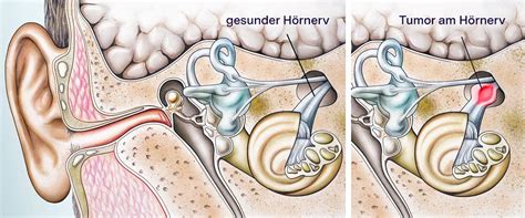 akustikusneurinom blutwerte