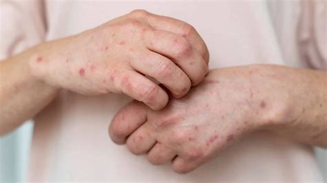 akut allergisk reaktion behandling