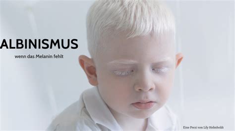 albinismus referat powerpoint