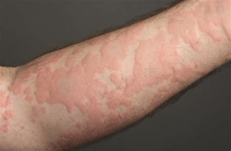 alergi kulit
