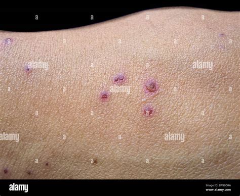 all about scabs