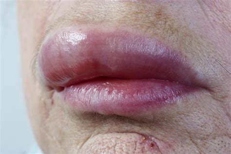 allergic reaction that makes lips swell causes treatment