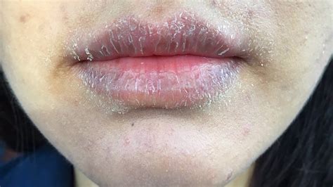 allergic reaction that makes lips swelling dry