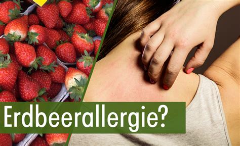 allergie bei erdbeeren