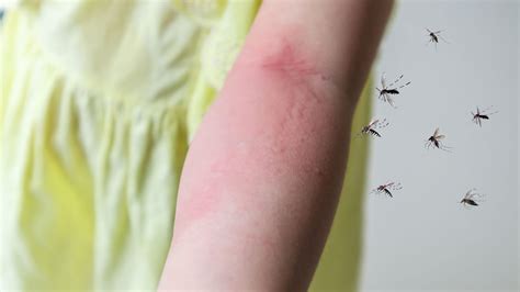 allergisch mückenstich