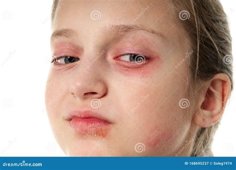 allergische reactie ogen