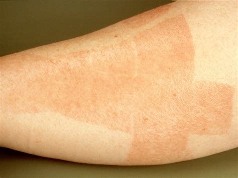 allergische reactie zeep