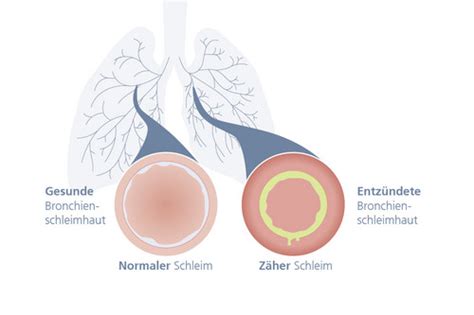 allergischer husten schleim
