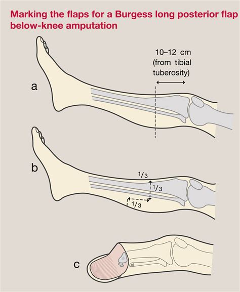 Amputation Surgery And Lower Limb Prosthetics
