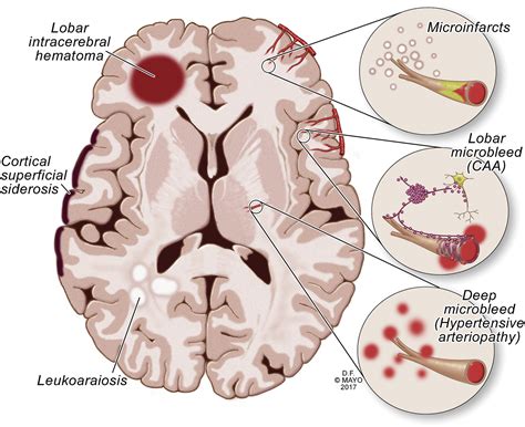 Amyloid Blood Levels Associated With Brain Changes In Types Of Changes In Science - Types Of Changes In Science