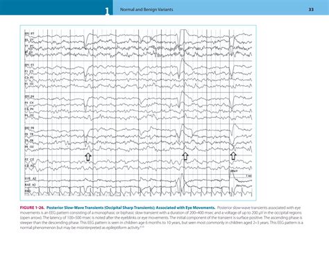 An Atlas Of Eeg Patterns