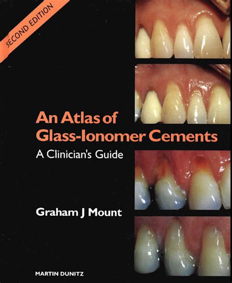 Full Download An Atlas Of Glass Ionomer Cements A Clinicians Guide 