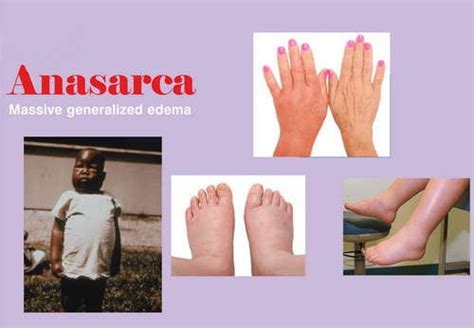 Anasarca Icd 10