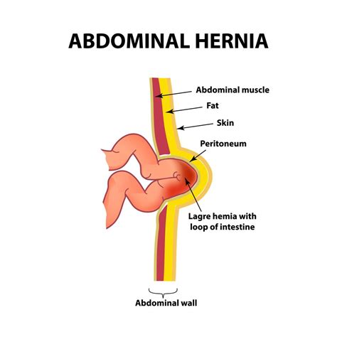 Anatomy Of A Hernia