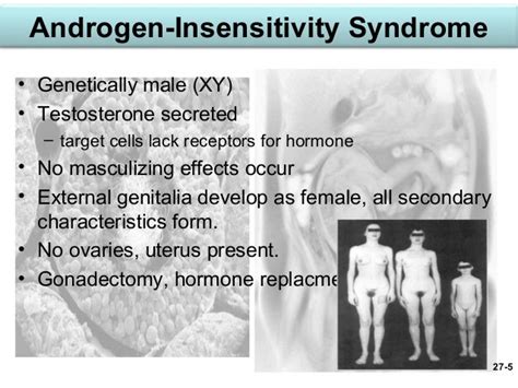 androgen insensitivity syndrome powerpoint