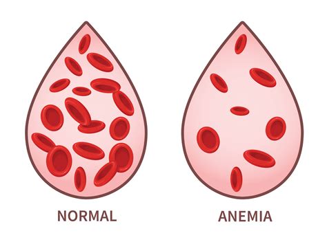 anemia 란