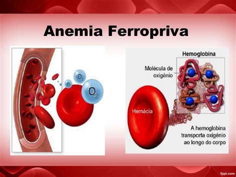 Anemia Ferropriva Cid