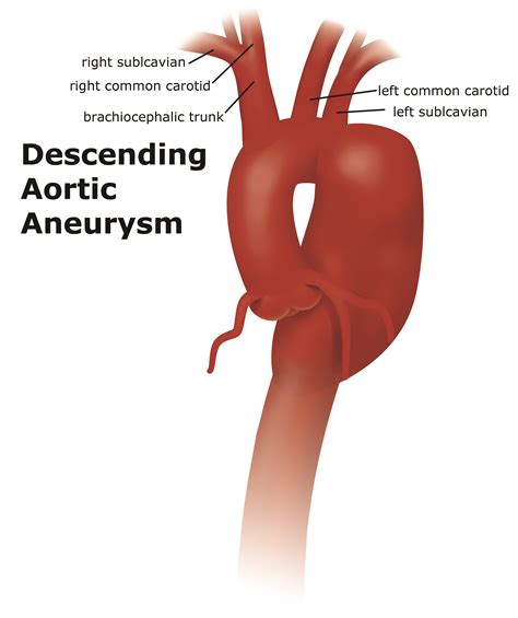 aneurysm